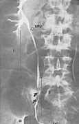 Image result for Long Tunnel Ureter