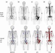 Image result for CT Scan Bone Cancer