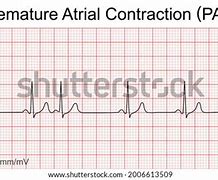 Image result for Premature Atrial Contraction