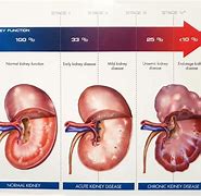 Image result for Chronic Kidney Disease