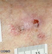 Image result for Skin Cancer Lower Back