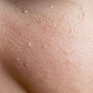 Image result for Benign Skin Bumps