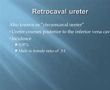 Image result for Retrocaval Ureter vs Normal