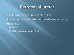 Image result for Postcaval Ureter