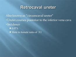 Image result for Retrocaval Ureter MRI