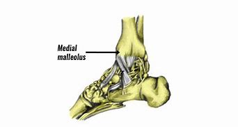 Image result for Area Distal to Lateral Malleolus