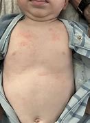 Image result for Peanut Butter Allergy Rash