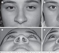 Image result for Nasal Alar Groove