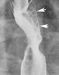 Image result for Esophageal Sphincter Spasm