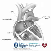 Image result for Septum Secundum