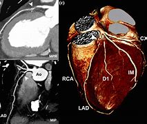 Image result for Coronary CT Angiography CTA