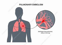 Image result for Pulmonary Embolism Post-Mortem Changes