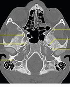 Image result for Orbital Anatomy in CT Scan