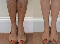 Image result for Dark Age Spots On Legs