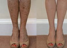 Image result for Dark Pigmentation On Legs