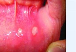 Image result for Vaping Mouth Ulcers