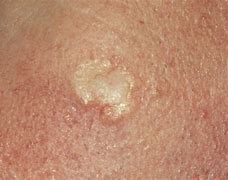 Image result for Basal Cell Carcinoma Lesions