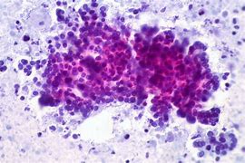 Image result for Pancreatic Adenocarcinoma