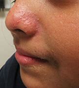 Image result for Hives with Pustules