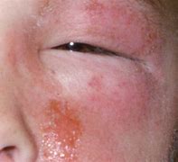 Image result for Poison Ivy Rash African American