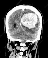 Image result for Meningioma CT Head