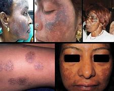 Image result for Ochronosis Appearance