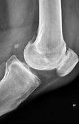 Image result for Patellofemoral Joint Space Narrowing