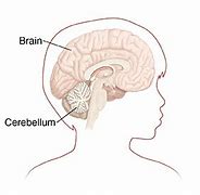 Image result for Medulloblastoma in Child