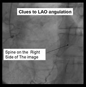 Image result for Angio Vue Choriocapillaris