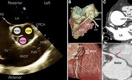 Image result for Right Ventricular Outflow Tract