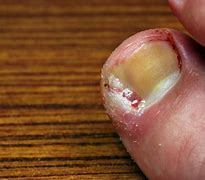 Image result for Ingrown Tools