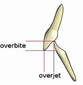 Image result for Overjet Bite