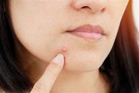 Image result for Big Pimple in the Face