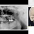 Image result for Pterygoid Plate