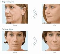 Image result for Radiesse for Face