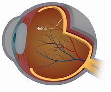 Image result for Damaged Retina