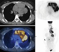 Image result for Hodgkin Lymphoma PET/CT