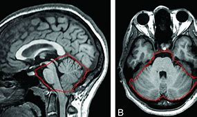 Image result for Extra-Axial Posterior Fossa Mass