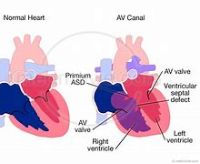 Image result for Unbalanced AV Canal