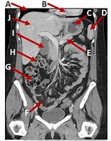 Image result for Abdomen CT Cor