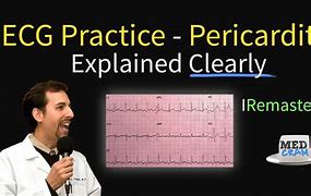 Image result for Pericarditis EKG Findings Example