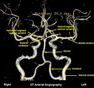 Image result for Brain MRI Angiogram