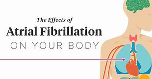 Image result for Atrial Fibrillation On the Body