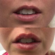 Image result for Hylauronic Pen Lip Filler