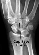 Image result for Capitate Bone Pain