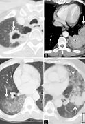 Image result for Lung Cancer On CT