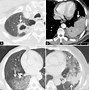 Image result for Lung Cancer On CT