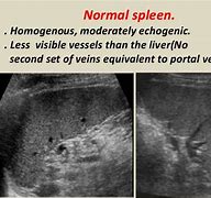 Image result for Spleen Infarction Ultrasound