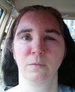 Image result for Poison Ivy Rash Face