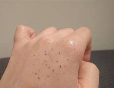 Image result for Blackhead Removal Before and After